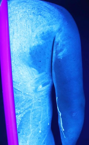 Eine UV-Lampe zeigt die Verteilung der Heilcreme am Körper. Die von der Krätzmilbe befallenen Regionen wurden durch den Patienten fälschlicherweise ausgespart. Durch diesen Anwendungsfehler kann die beste Medizin nicht heilen. (Foto: Wolfgang Pöppl)