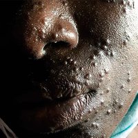 Tansanische Patientin mit Knötchen an der Haut. Ein Hautarzt kann mit diesem Bild dem Arzt vor Ort bei der Diagnose und Therapie zur Seite stehen. (Foto: Romina Nemecek)