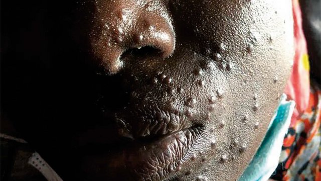 Tansanische Patientin mit Knötchen an der Haut. Ein Hautarzt kann mit diesem Bild dem Arzt vor Ort bei der Diagnose und Therapie zur Seite stehen. (Foto: Romina Nemecek)